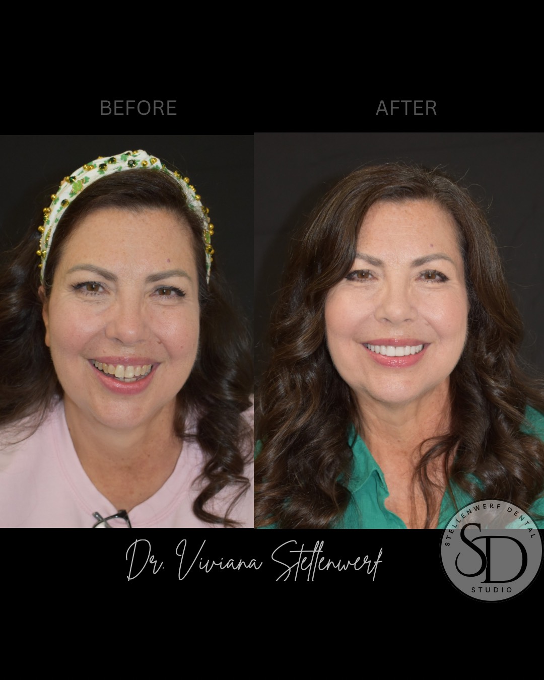 Veneers - Before and After 2