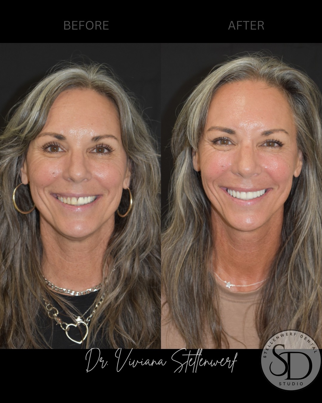 Veneers - Before and After 3