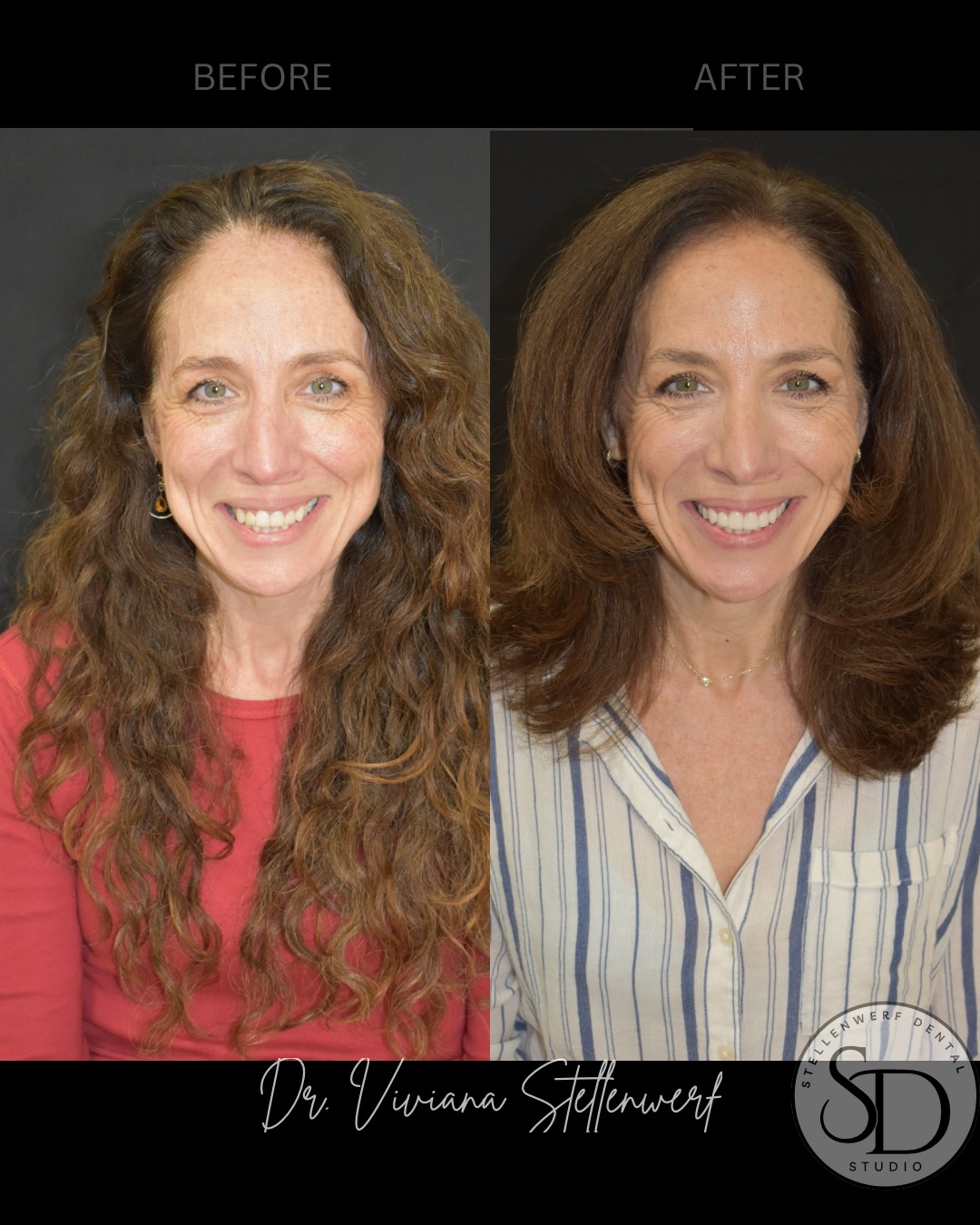 Veneers - Before and After 1