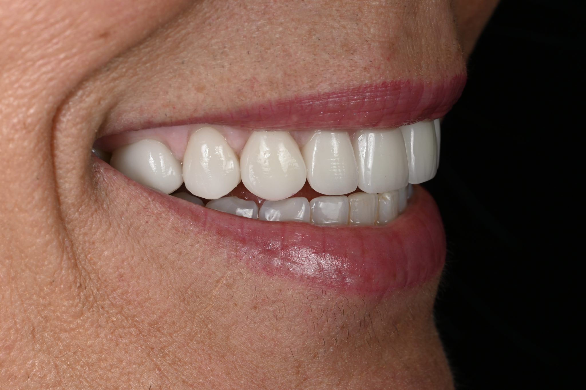 Porcelain veneers smile by Dr. Viviana Stellenwerf in Kingwood, TX
